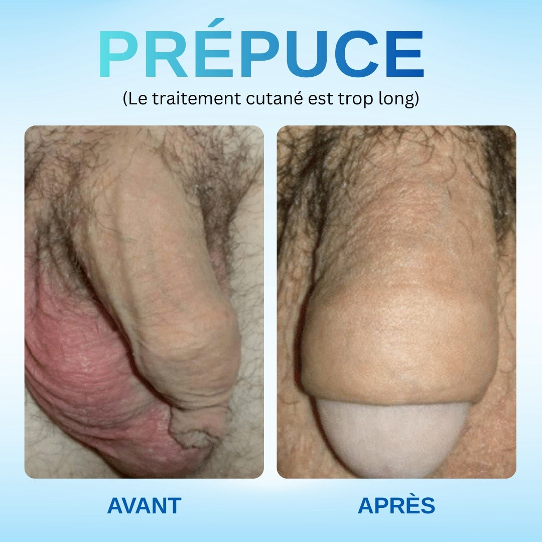 🛡️RZXEA™ Gel Correcteur de Prépuce Redondant -🌟 Solution Naturelle et Efficace pour Réduire💪