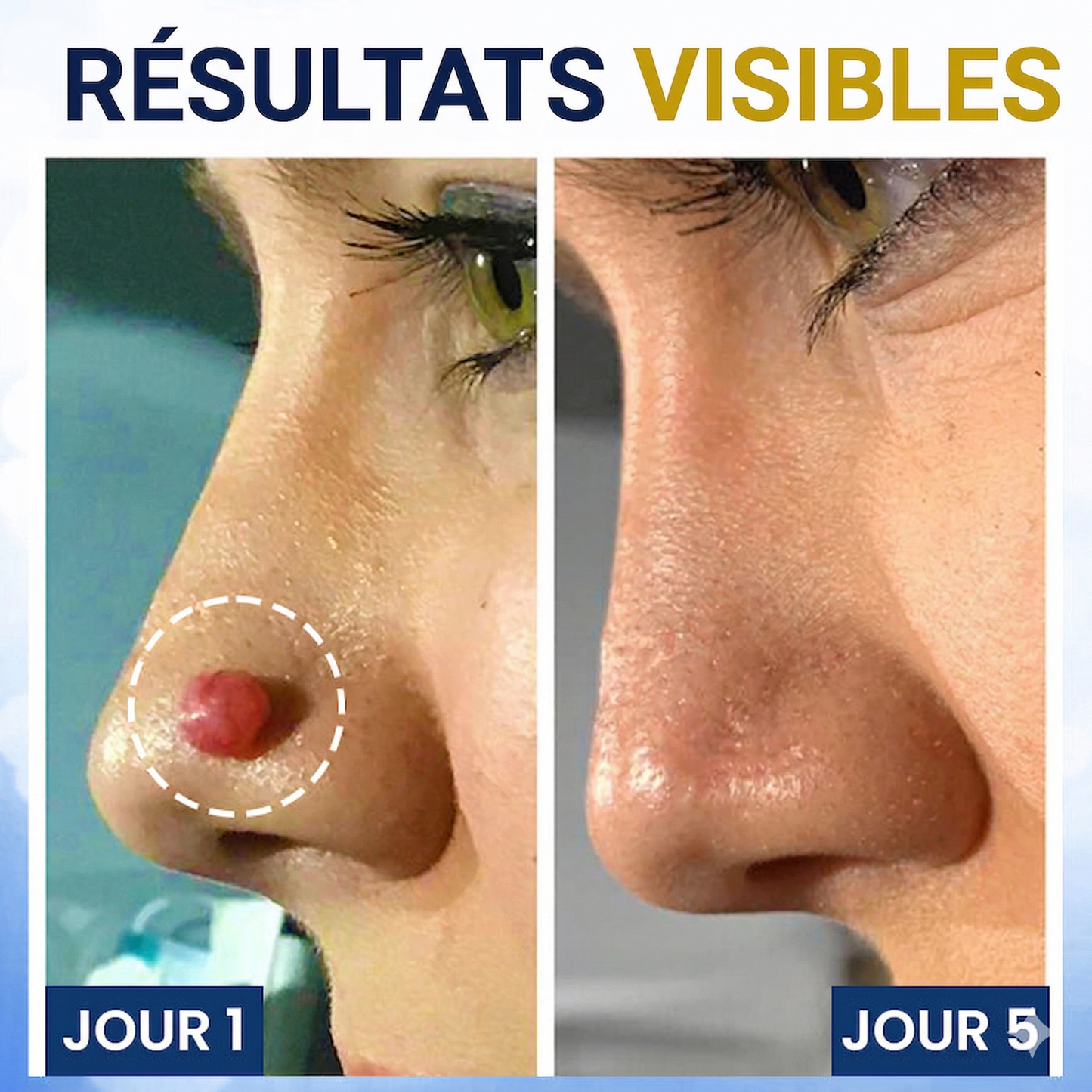 AEXZR® Spray de traitement cryogénique pour verrues et kératoses: Élimination rapide des verrues et de la kératose – Résultats visibles en 7 jours ✨